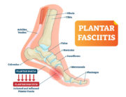 causes of plantar fasciitis featured